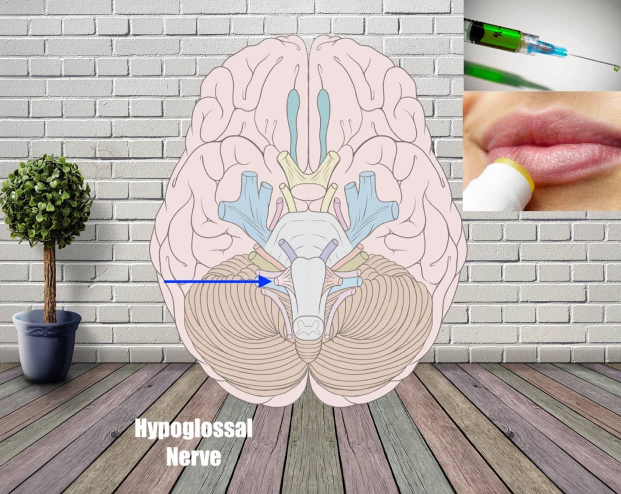 hyppglossal nerve example